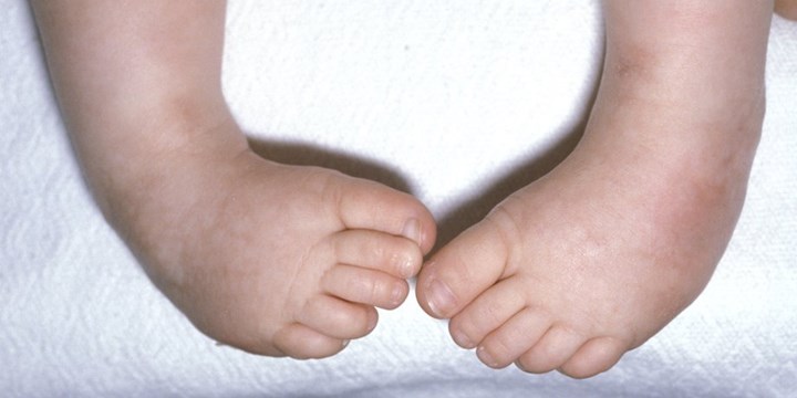 clubfoot image